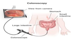 Colonoscopy