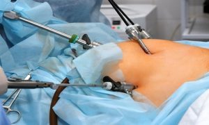 ল্যাপারোস্কোপিক হার্নিয়া সার্জারি