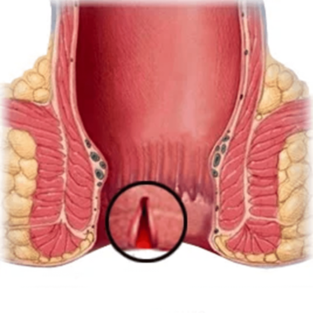 এনাল ফিশার জটিলতা
