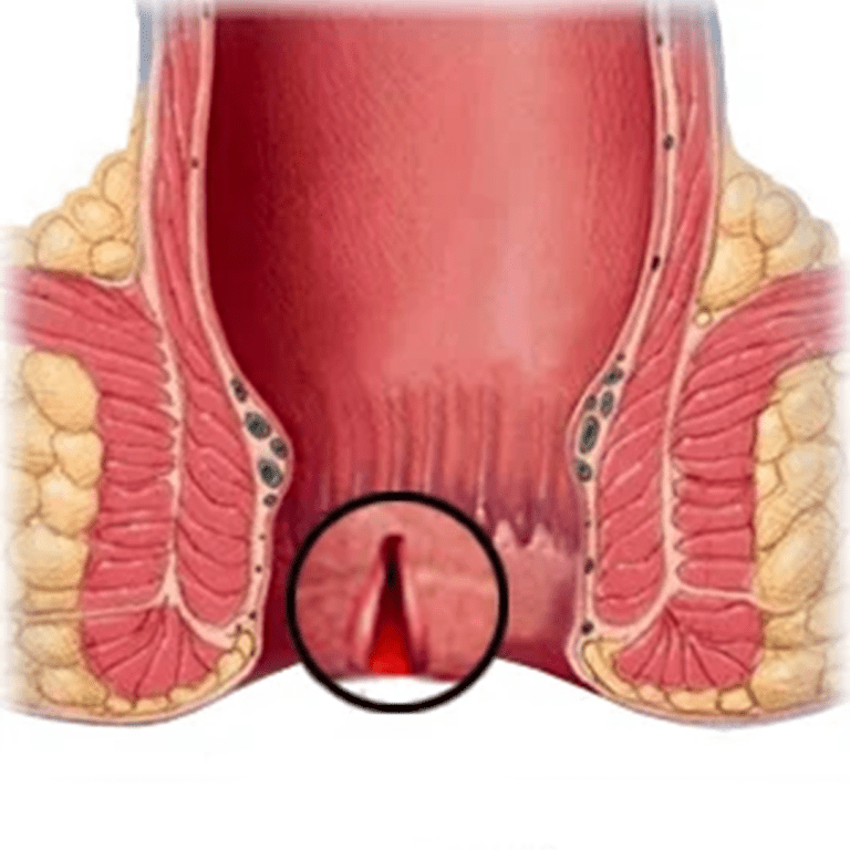 এনাল ফিশার জটিলতা